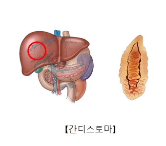 간디스토마