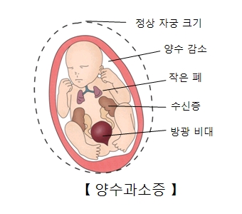 양수과소증