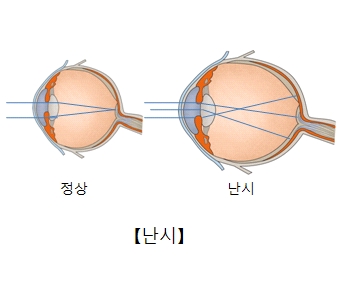 난시