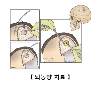 뇌농양