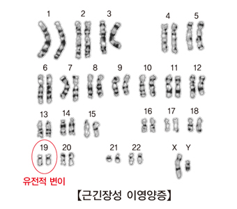 근긴장성 이영양증