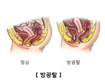 방광탈