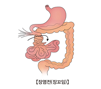 장폐색