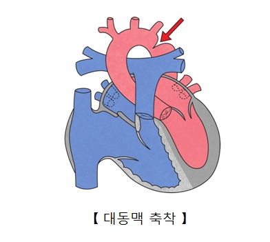 대동맥협착증