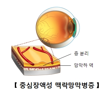 중심장액성 맥락망막병증