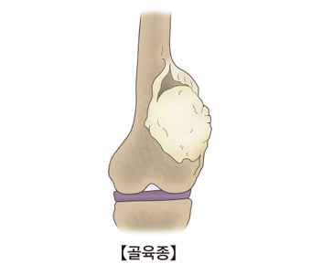 육종