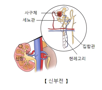 신부전