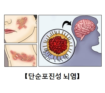 단순포진성 뇌염