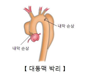 대동맥 박리