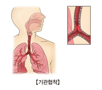 기관협착