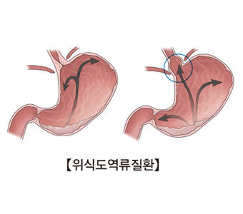 위식도 역류성 질환