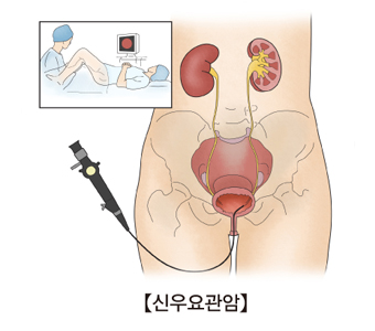 신우요관암