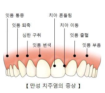 만성 취주염