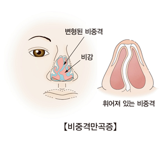 비중격만곡