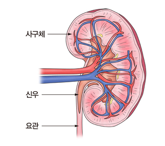 말기 신질환