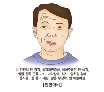 안면마비