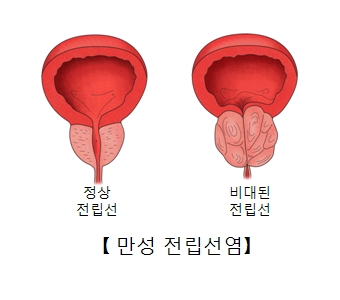 만성 전린선염