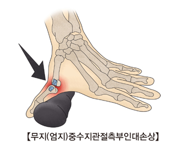 무지(엄지)중수지관절측부인대손상