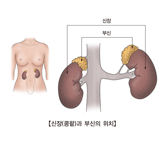 급성 세뇨관 간질성 신염