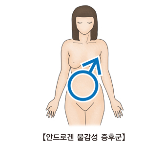 안드로겐 불감성 증후군