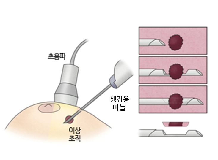 진공 보조 유방 생검술