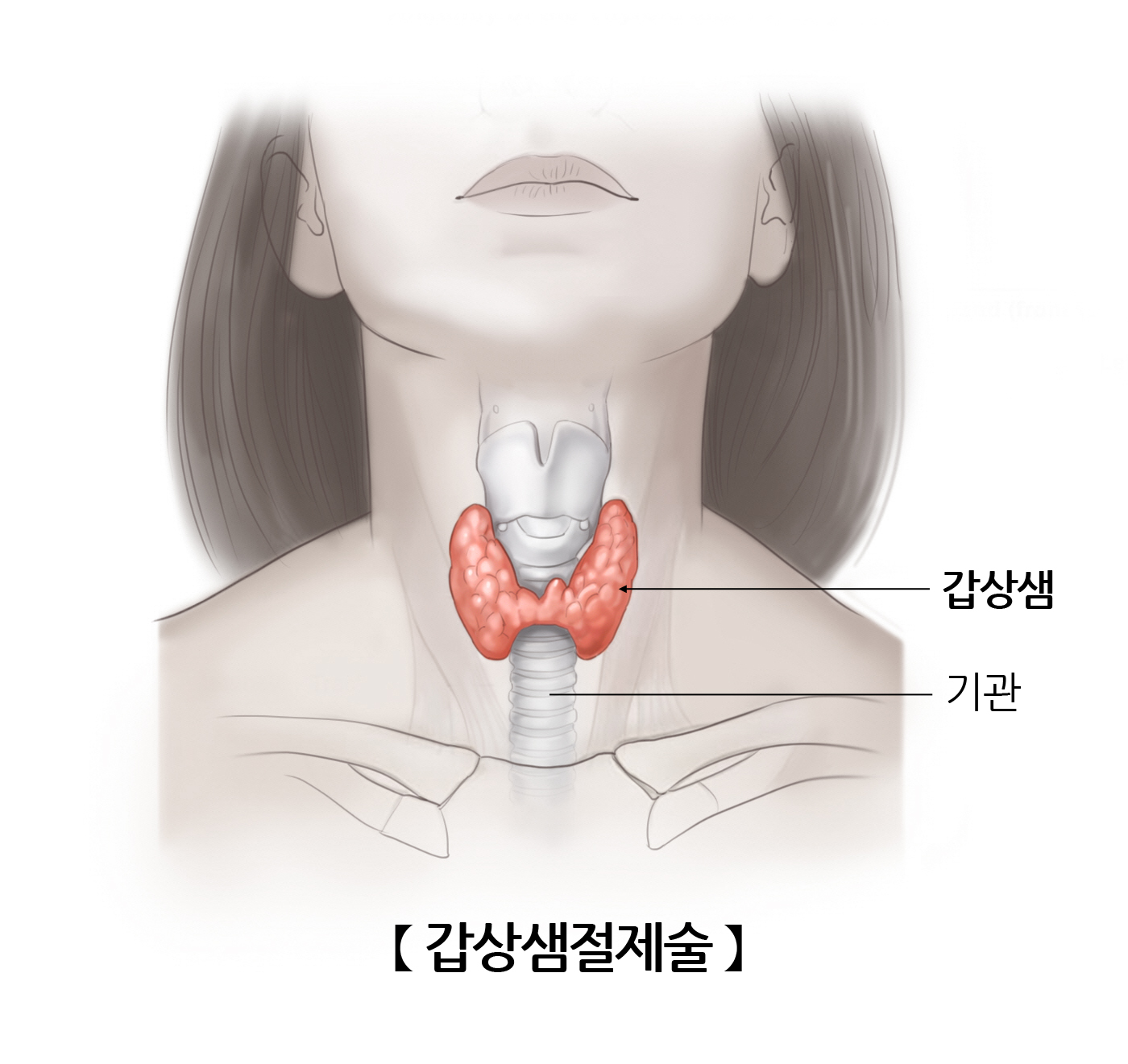 갑상선절제술